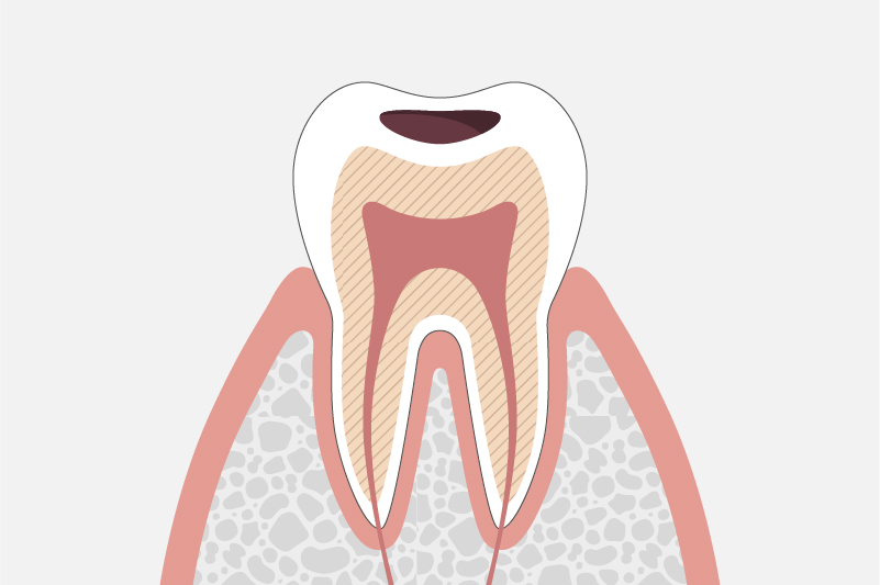 象牙質に達した虫歯